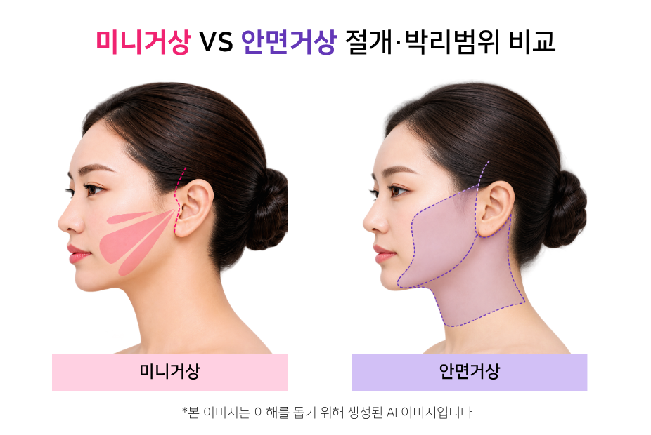 미니거상과 안면거상의 절개 및 박리 범위를 비교한 그림