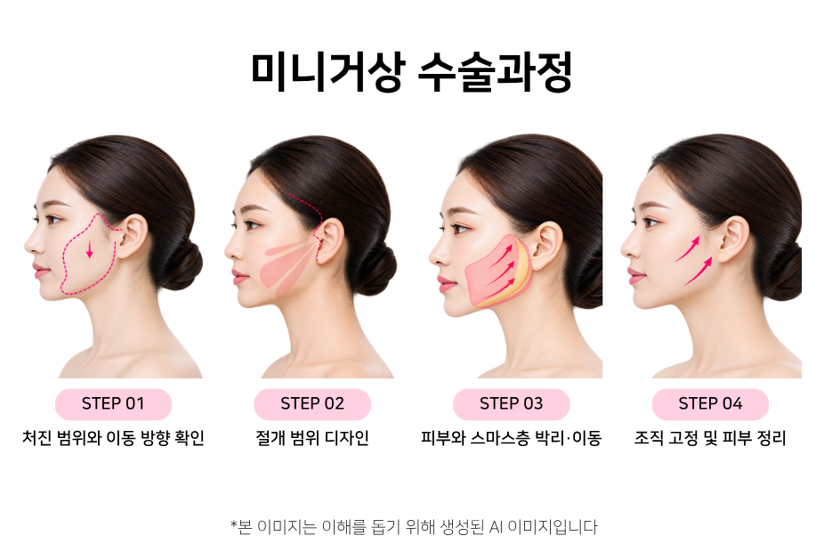 미니거상 수술 과정을 처짐 확인부터 조직 고정까지 4단계로 정리