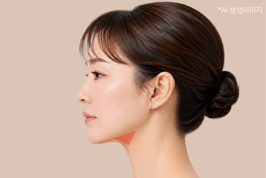코르셋 경부거상술의 턱밑 절개 부위를 표시한 모델 이미지